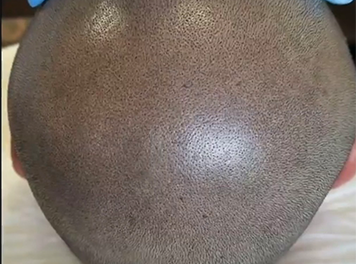 SMP (Medical Scalp Micro-Pigmentation)